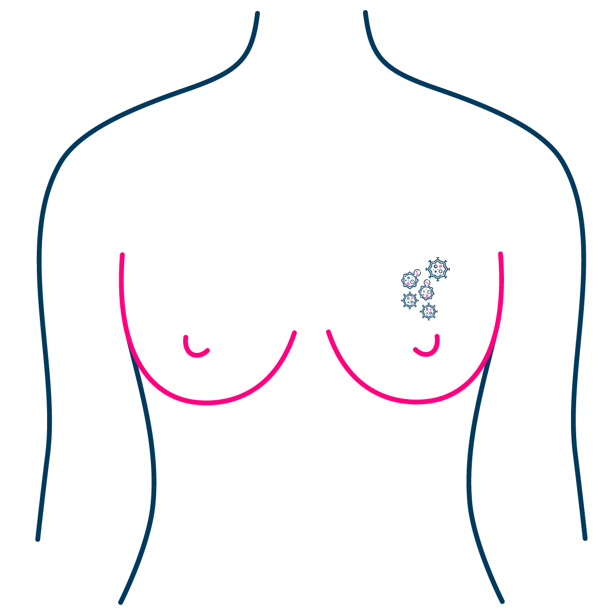 Breast Cancer Treatment