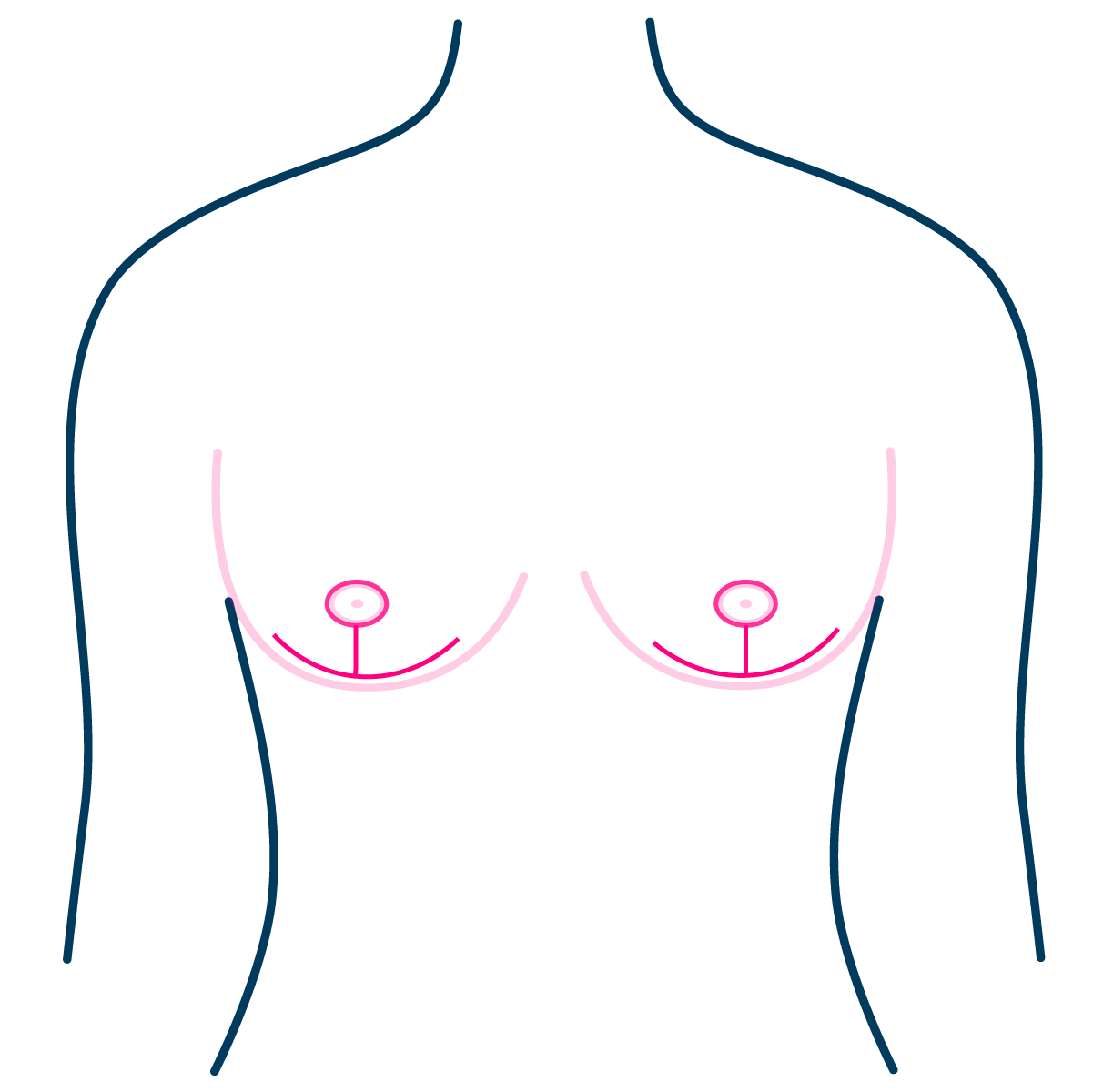 Double Incision Mastectomy