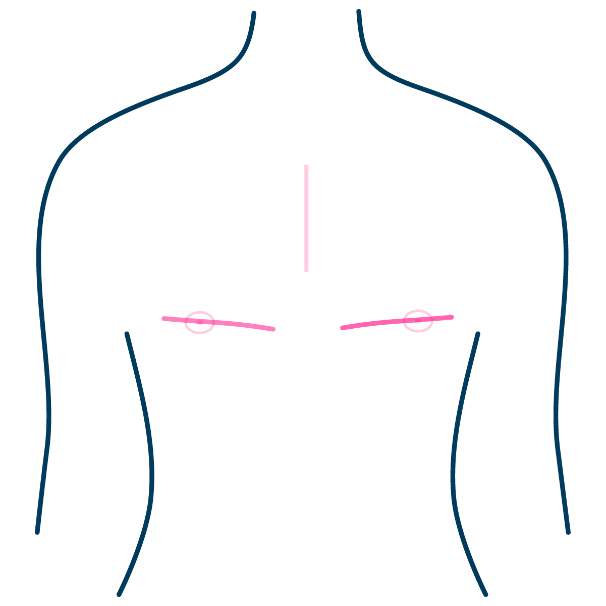 Double Incision Mastectomy High Scar