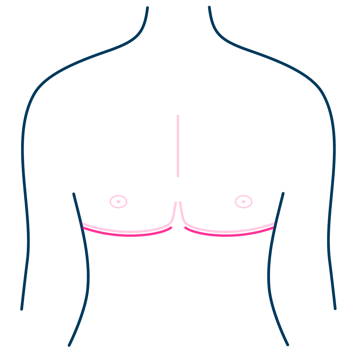 Double Incision Mastectomy Scar Placement