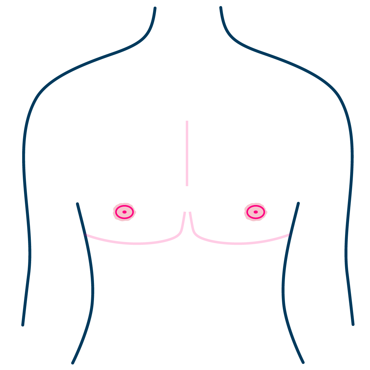 Free Nipple Graft - Complication - Hypertrophic Scar - thickened scar around the nipple