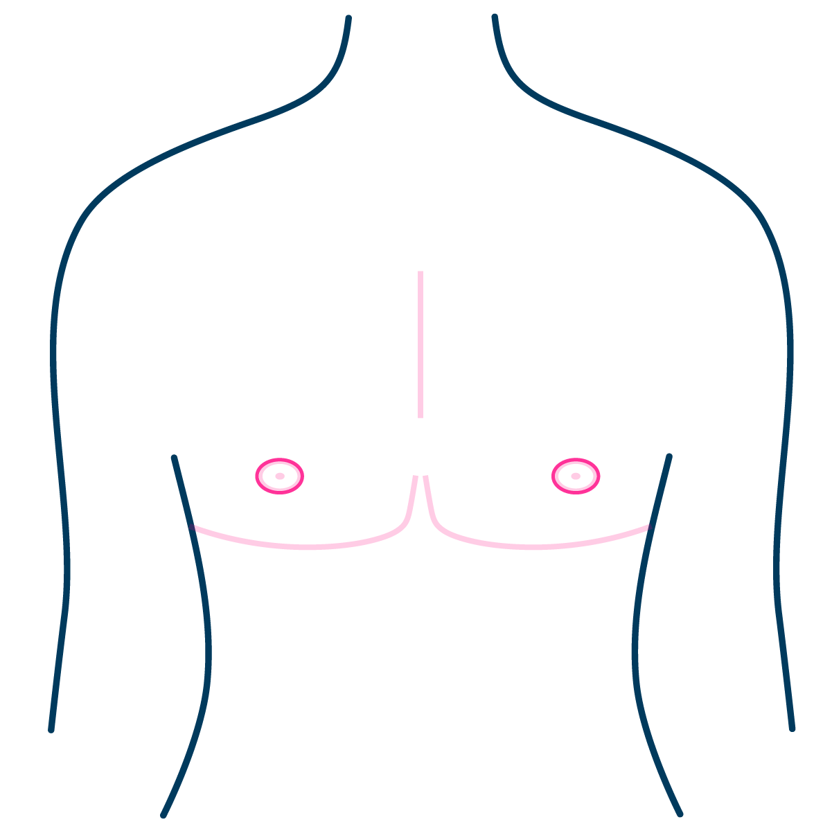 Single Incision Mastectomy