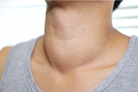 An image of an enlarged goitre representative of thyroid conditions or thyroid cancer.